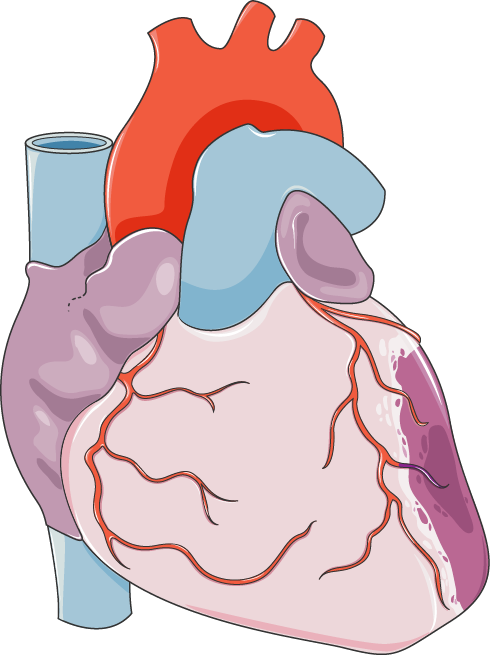 Infarto agudo de miocardio eleva las troponinas cardíacas