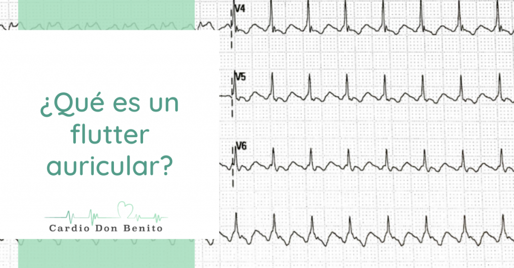 Qu Es Un Flutter Auricular En Qu Se Parece A La Fibrilaci n Auricular Qu Es Un Flutter Auricular En Qu Se Parece A La Fibrilaci n Auricular