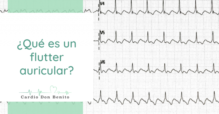 Qu Es Un Flutter Auricular En Qu Se Parece A La Fibrilaci n Auricular Qu Es Un Flutter Auricular En Qu Se Parece A La Fibrilaci n Auricular
