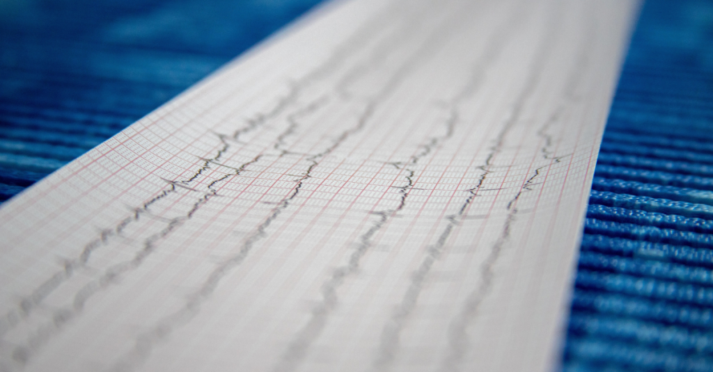 Tira de ritmo ECG
