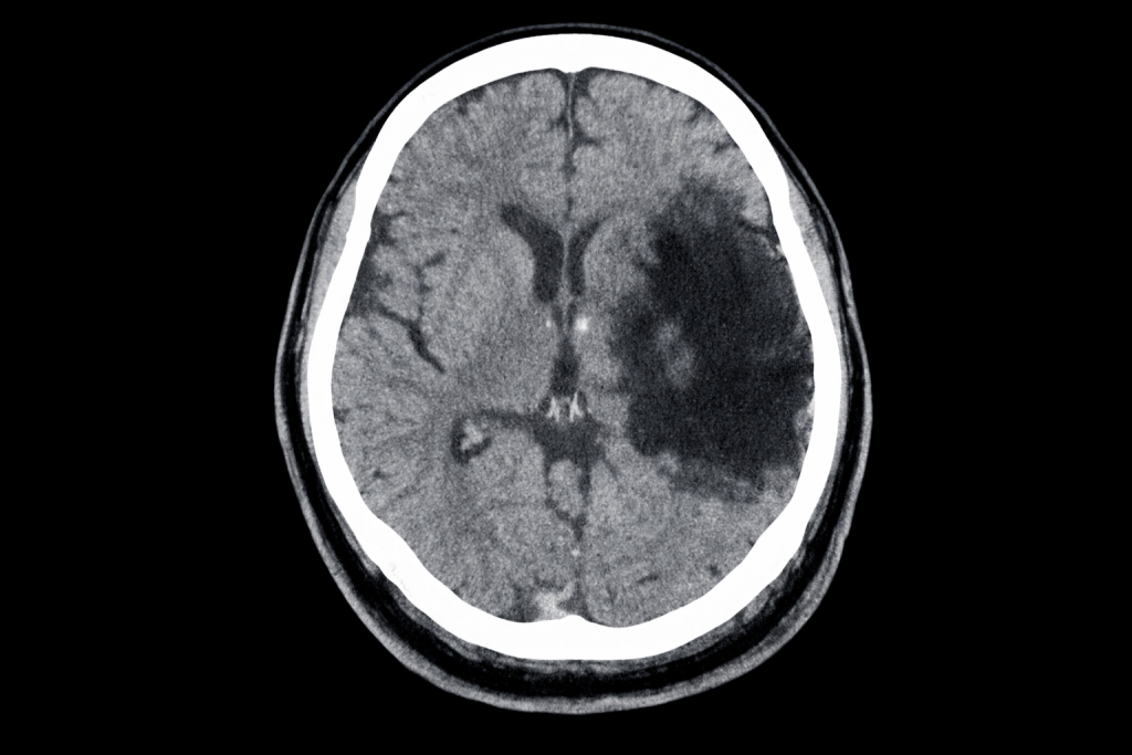 Ictus en la fibrilación auricular