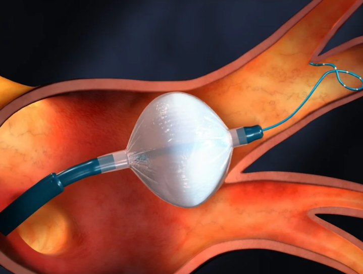 Ablación de fibrilación auricular